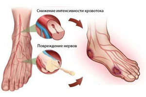 Рекомендации как правильно бинтовать ногу эластичным бинтом при варикозе