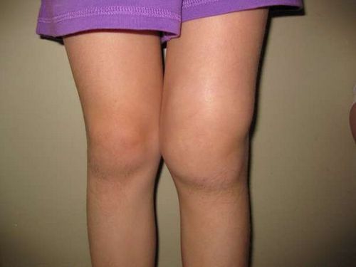 Симптомы и лечение артроза коленного сустава в домашних условиях