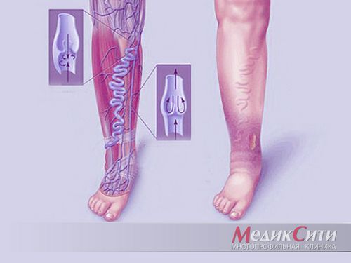 Симптомы, диагностика, фото и лечение тромбоза глубоких вен нижних конечностей