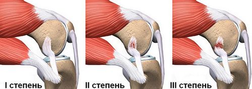 Травмы связок колена виды повреждений и способы реабилитации
