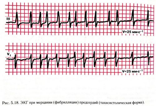 Экг при мерцательной аритмии и признаки заболевания, выявляемые при диагностике пульса тонометром с
