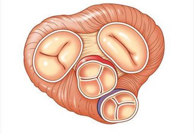 Что такое уплотнение стенок аорты и створок аортального клапана