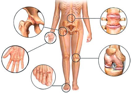 Список анализов для диагностики ревматоидного артрита