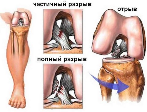 Разрыв крестообразной связки колена, частичный и полный симптомы и лечение