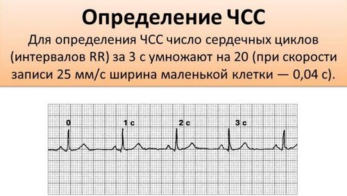 Экг ребенку расшифровка, норма в таблице, нарушения работы сердца на кардиограмме