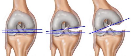 Разрыв связок коленного сустава лечение