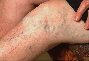 Синие вены на ногах - причины и способы лечения