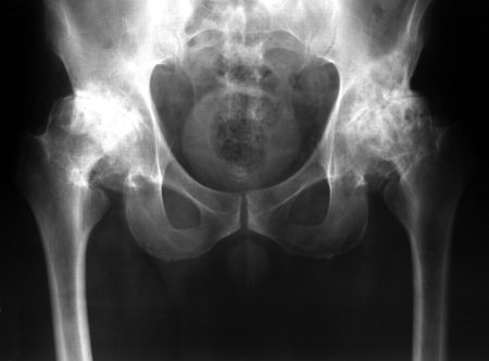 Рентген тазобедренного сустава подготовка и проведение в отличии от мрт