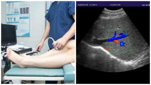 Уздг сосудов нижних конечностей (допплерография артерий и вен) что это такое и как делают процедуру
