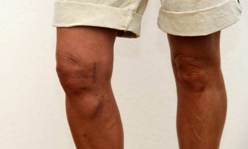 Симптомы и лечение артроза коленного сустава в домашних условиях