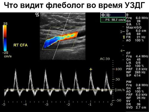 Уздг сосудов нижних конечностей (допплерография артерий и вен) что это такое и как делают процедуру