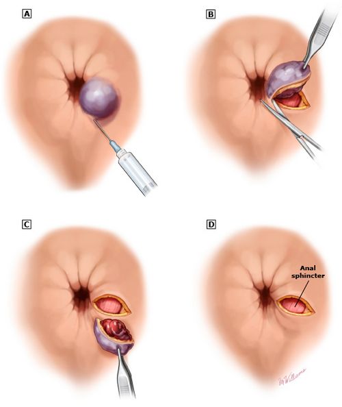 Тромбэктомия геморроидального узла операция, подготовка, реабилитация
