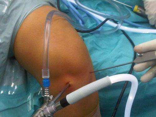 Разрыв коленной крестообразной связки особенности операции