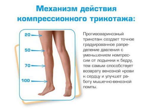 Чулки от варикоза вен на ногах как подобрать для женщин и мужчин
