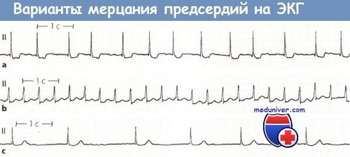 Экг при мерцательной аритмии и признаки заболевания, выявляемые при диагностике пульса тонометром с