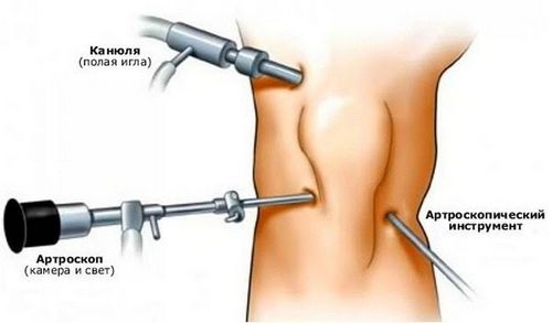 Разрыв крестообразной связки колена, частичный и полный симптомы и лечение