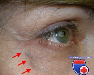 Расширение вен глаза причины, симптомы, лечение, flebdoc