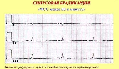 Синусовый ритм сердца на экг - что это значит в диагностике кардиопатологий