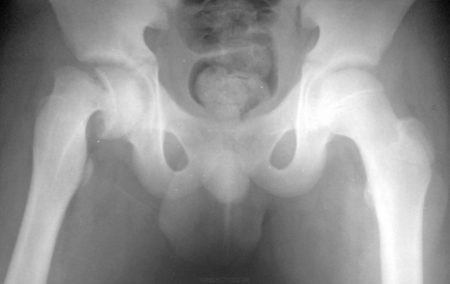 Рентген тазобедренных суставов у детей норма, расшифровка, патология