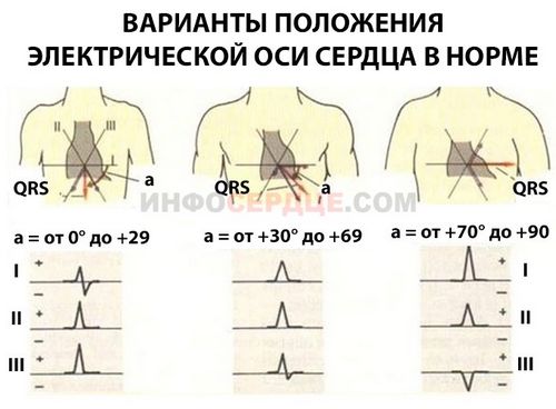 Эос (электрическая ось сердца) положение, отклонения