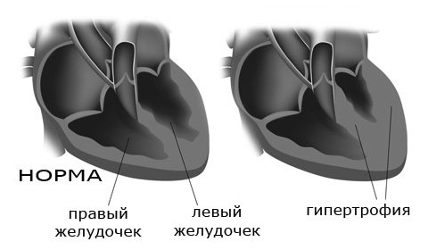 Эос (электрическая ось сердца) положение, отклонения