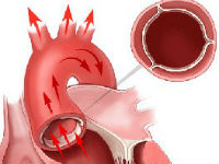 Что такое уплотнение стенок аорты и створок аортального клапана