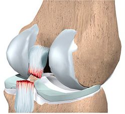 Разрыв связок коленного сустава лечение, симптомы, причины травмы
