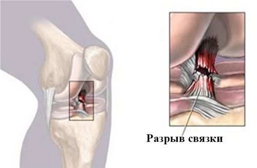 Разрыв передней крестообразной связки коленного сустава лечение