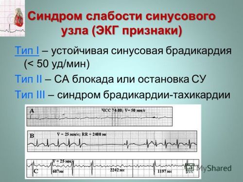 Синусовый ритм на экг что это такое, расшифровка результатов кардиограммы