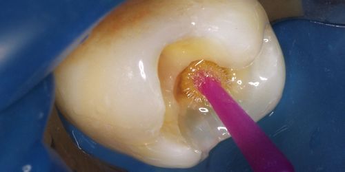 Адгезивные системы и что такое адгезия в стоматологии