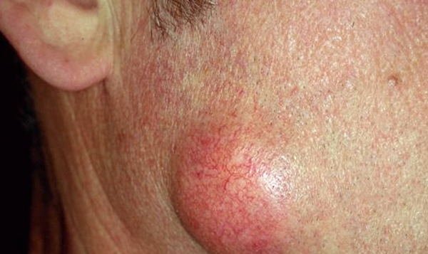 Жировики на лице – причины дефекта и способы эффективного лечения