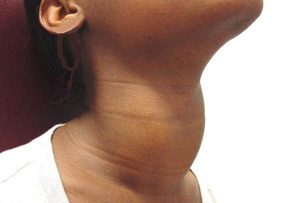Болезни щитовидной железы 21 века — 7 самых распространенных заболеваний щитовидки
