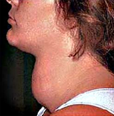 Болезни щитовидной железы 21 века — 7 самых распространенных заболеваний щитовидки