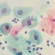 Chlamydia trachomatis проявления, анализы, лечение. Anti-Chlamydia trachomatis IgG значение