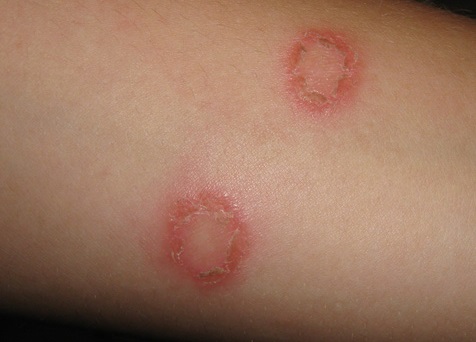 Грибковые заболевания кожи фото, симптомы, названия видов микоза, методы лечения