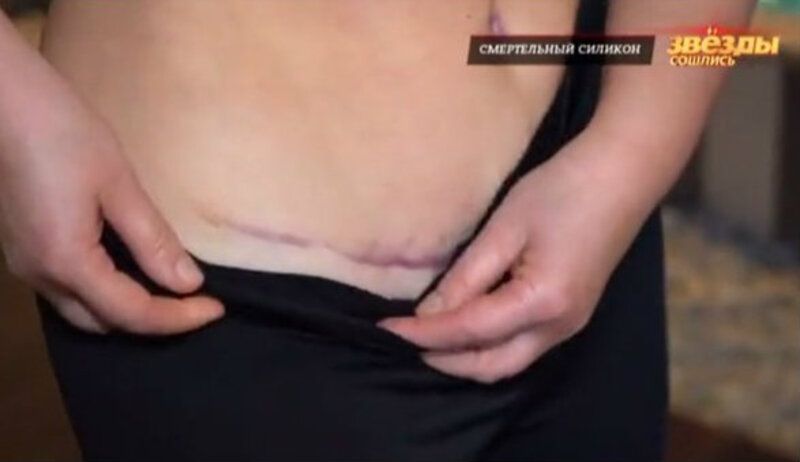 51-летняя дочь Лидии Федосеевой-Шукшиной показала шрамы после липосакции