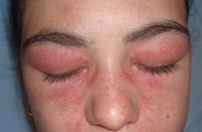 Аллергия на нарощенные ресницы. Симптомы, что делать, чтобы не снимать, последствия, капли