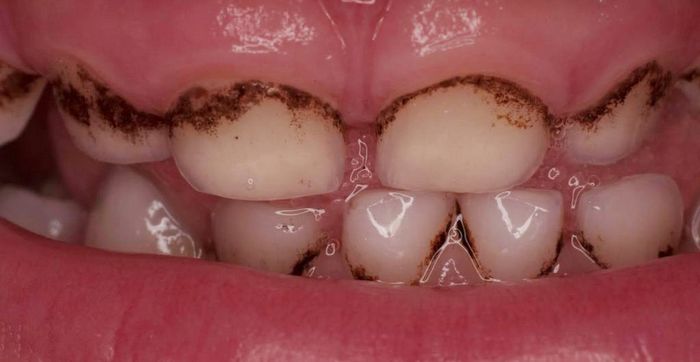 Зубной налет у детей — чем он опасен