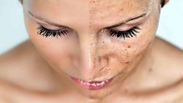 10 лучших отбеливающих кремов для лица – плюсы и минусы популярных средств для отбеливания кожи