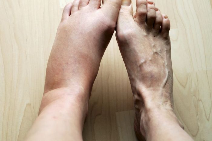 Как избавиться от отеков ног — 10 верных способов устранить отеки на ногах