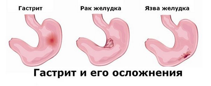 Разница между гастритом и язвой желудка